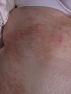 Allergie argas