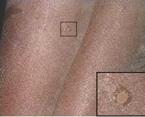 Ornithodoros moubata, morsures, photo CDC
